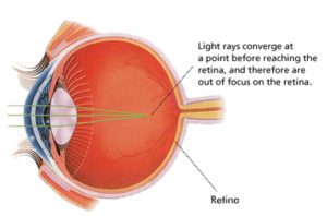 Diagram of The Eye. Light rays converge at a point before reaching the retina and therefore are out of focus on the retina.