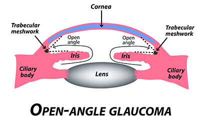Open Angle Glaucoma Diagram